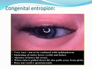 Congenital entropion:
 