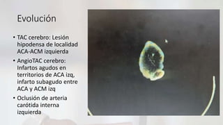 Evolución
• TAC cerebro: Lesión
hipodensa de localidad
ACA-ACM izquierda
• AngioTAC cerebro:
Infartos agudos en
territorios de ACA izq,
infarto subagudo entre
ACA y ACM izq
• Oclusión de arteria
carótida interna
izquierda
 