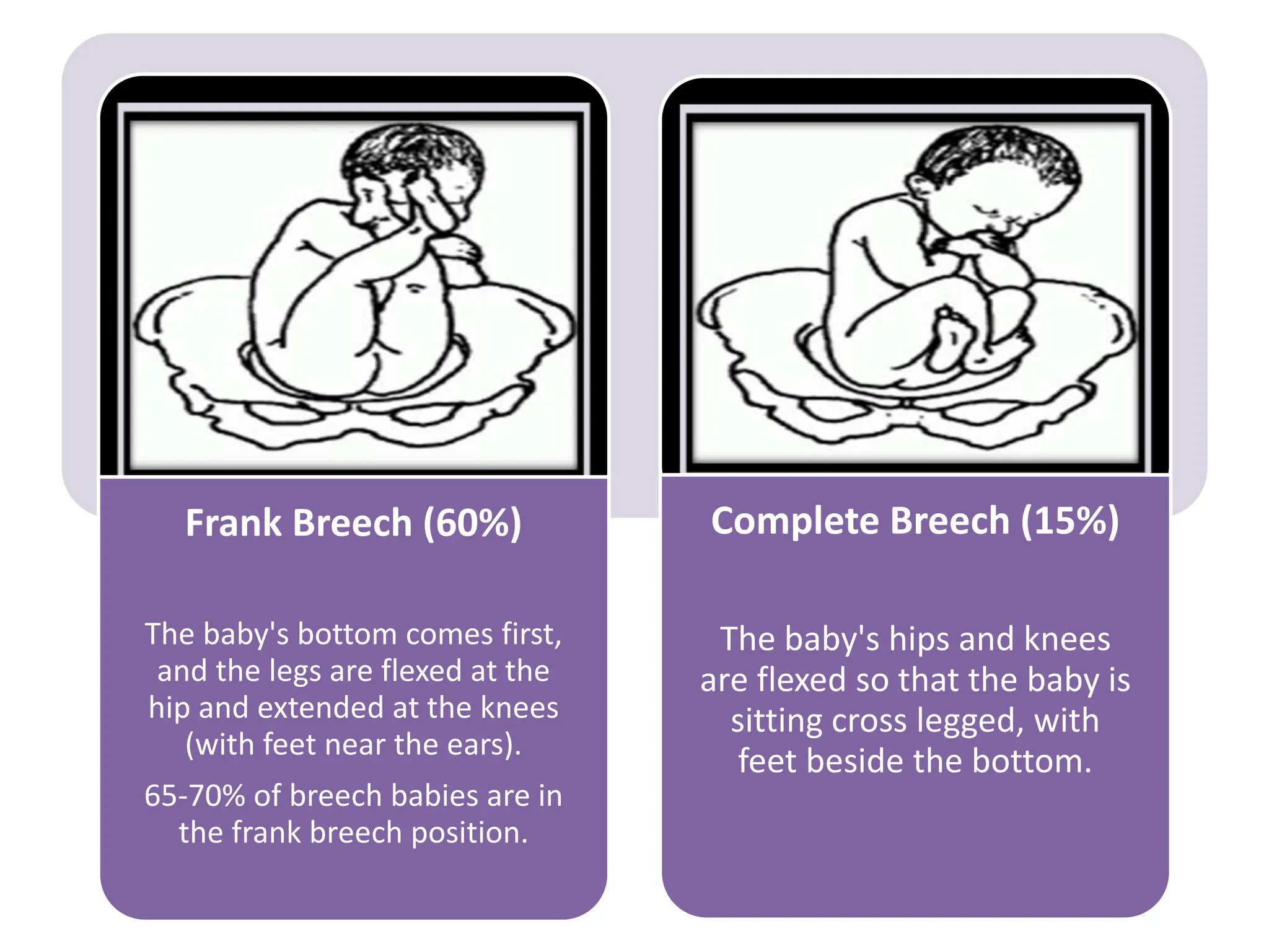 Frank Breech (60%)
The baby's bottom comes first,
and the legs are flexed at the
hip and extended at the knees
(with feet near the ears).
65-70% of breech babies are in
the frank breech position.
Complete Breech (15%)
The baby's hips and knees
are flexed so that the baby is
sitting cross legged, with
feet beside the bottom.
 