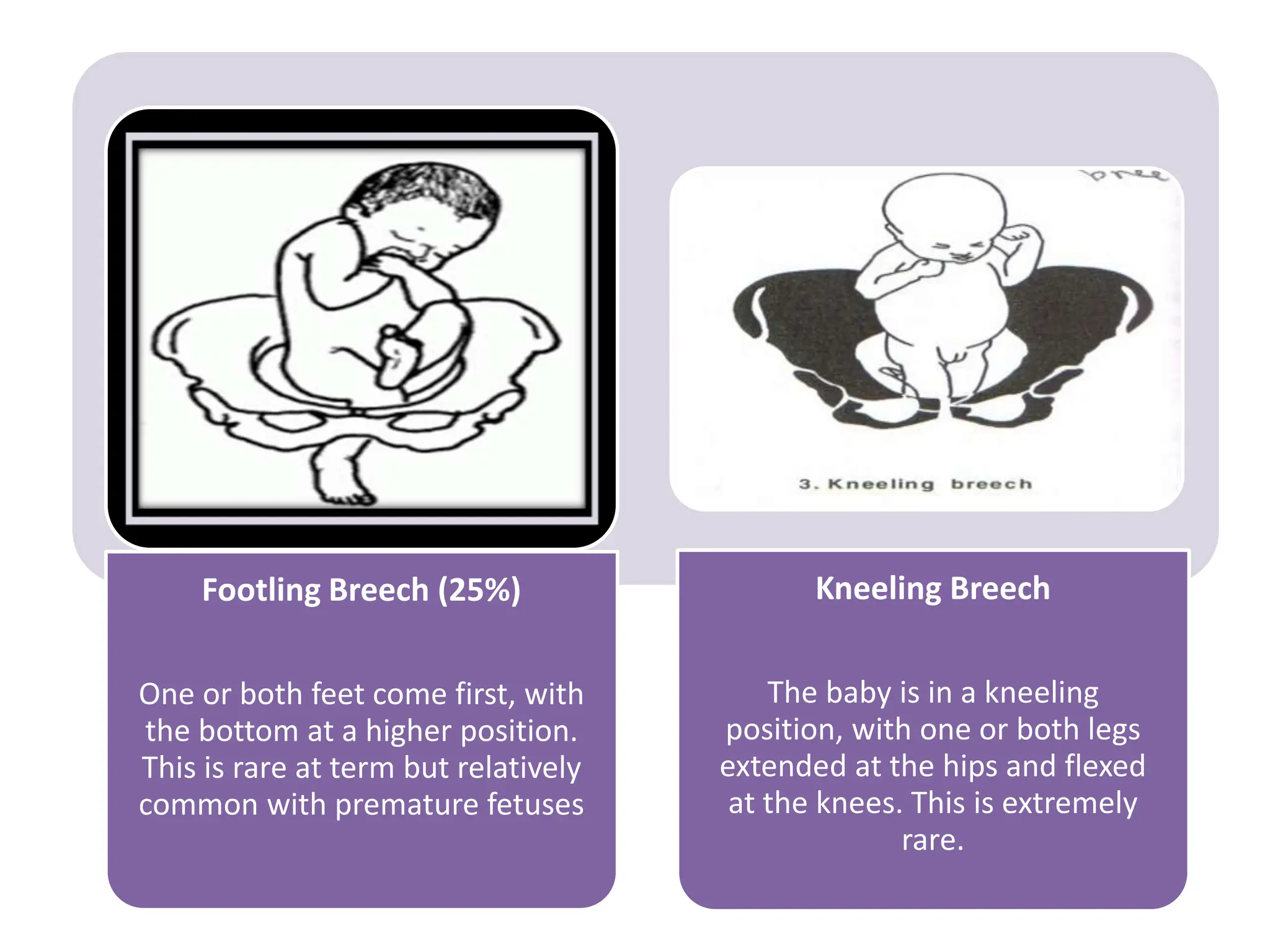 Footling Breech (25%)
One or both feet come first, with
the bottom at a higher position.
This is rare at term but relatively
common with premature fetuses
Kneeling Breech
The baby is in a kneeling
position, with one or both legs
extended at the hips and flexed
at the knees. This is extremely
rare.
 