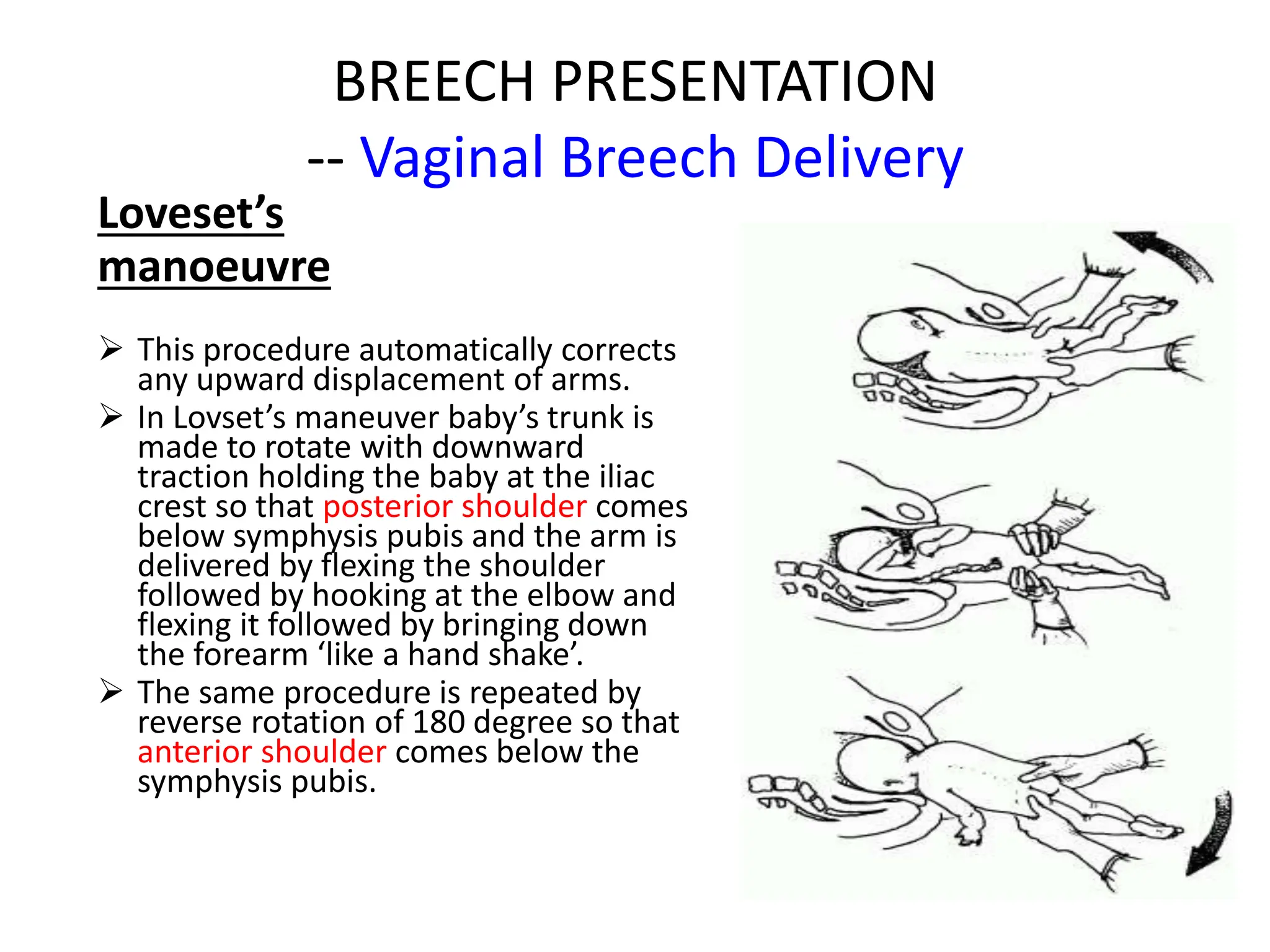 BREECH PRESENTATION
-- Vaginal Breech Delivery
Loveset’s
manoeuvre
 This procedure automatically corrects
any upward displacement of arms.
 In Lovset’s maneuver baby’s trunk is
made to rotate with downward
traction holding the baby at the iliac
crest so that posterior shoulder comes
below symphysis pubis and the arm is
delivered by flexing the shoulder
followed by hooking at the elbow and
flexing it followed by bringing down
the forearm ‘like a hand shake’.
 The same procedure is repeated by
reverse rotation of 180 degree so that
anterior shoulder comes below the
symphysis pubis.
 