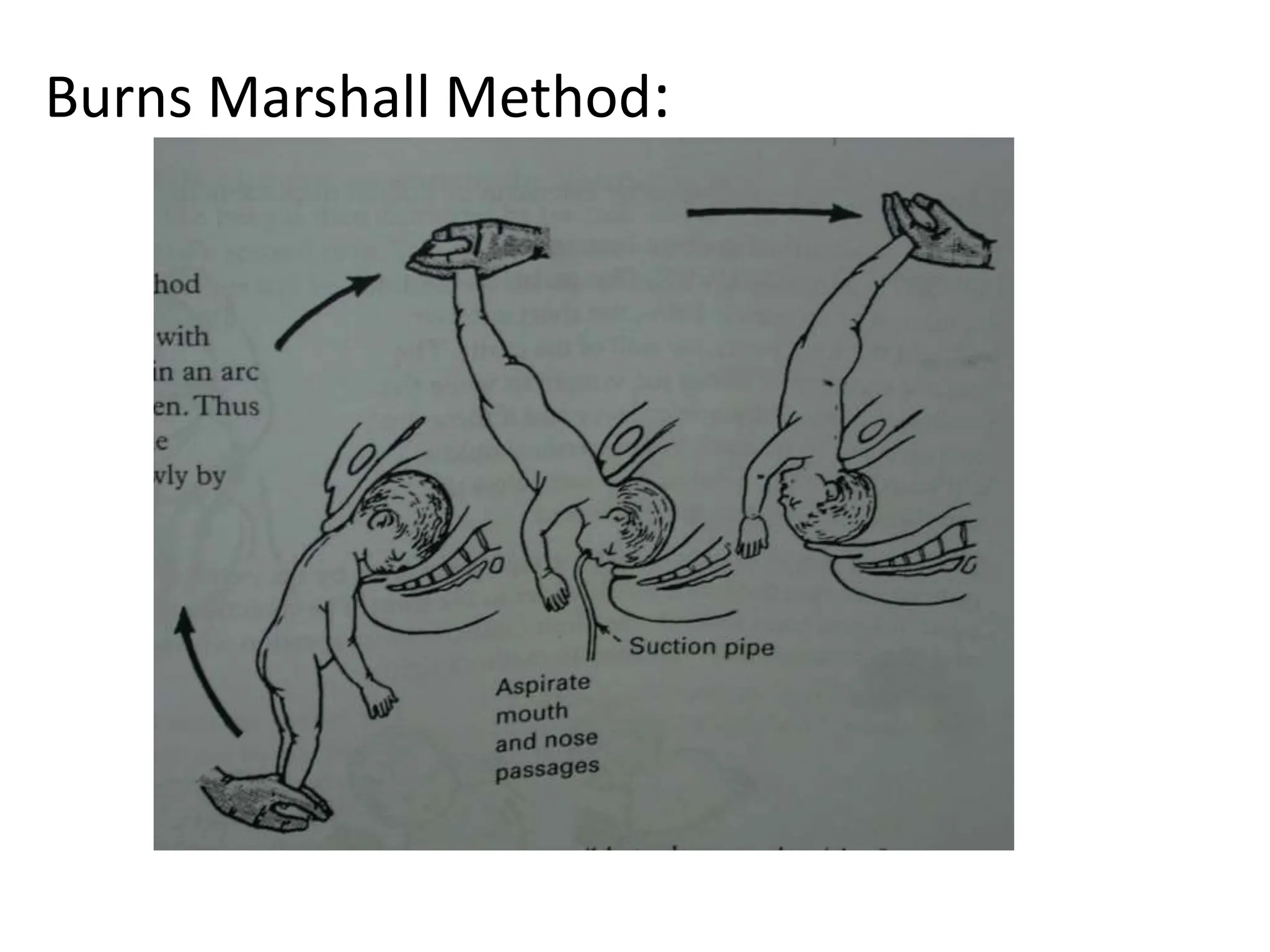 Burns Marshall Method:
 