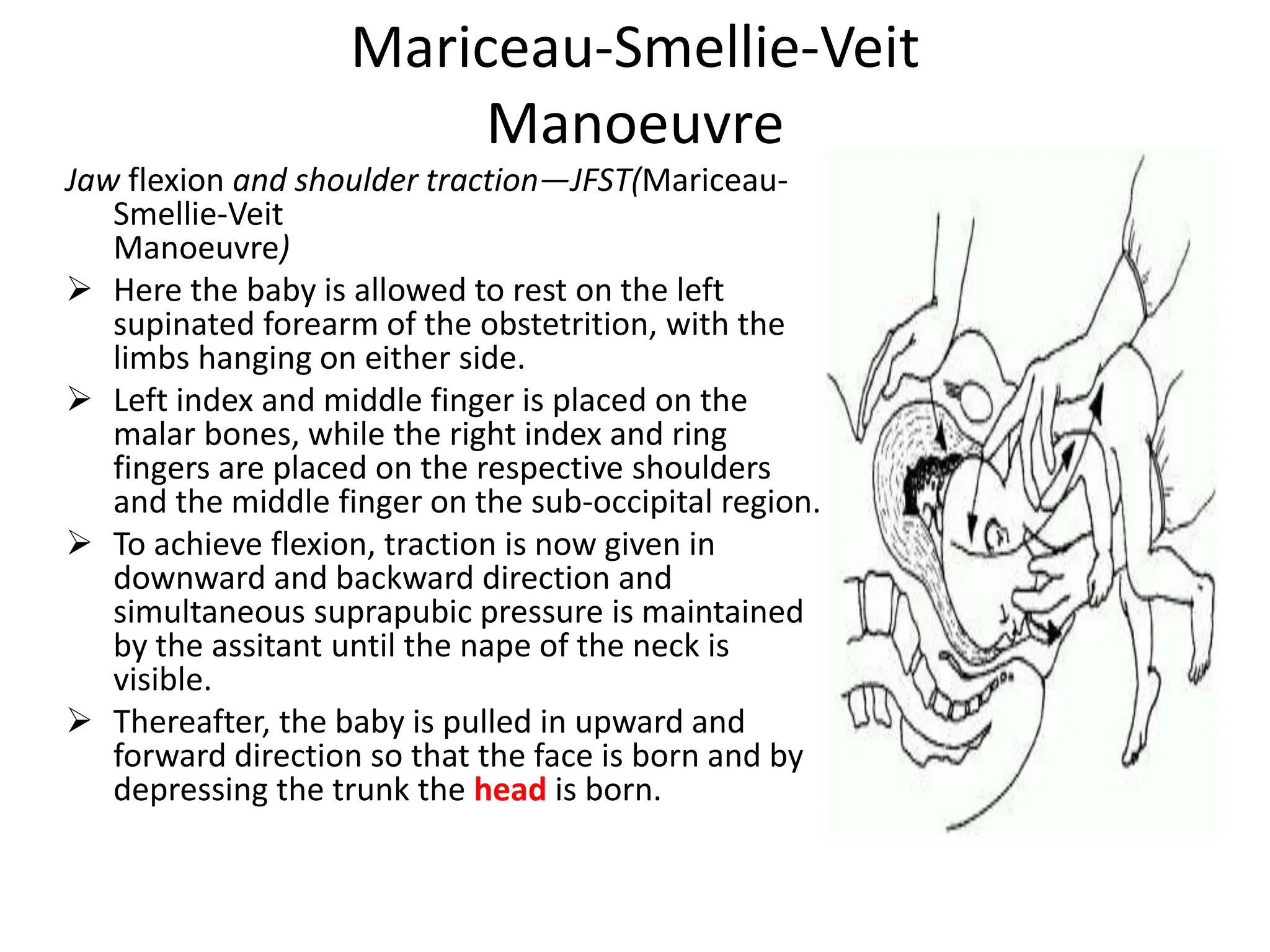 Mariceau-Smellie-Veit
Manoeuvre
Jaw flexion and shoulder traction—JFST(Mariceau-
Smellie-Veit
Manoeuvre)
 Here the baby is allowed to rest on the left
supinated forearm of the obstetrition, with the
limbs hanging on either side.
 Left index and middle finger is placed on the
malar bones, while the right index and ring
fingers are placed on the respective shoulders
and the middle finger on the sub-occipital region.
 To achieve flexion, traction is now given in
downward and backward direction and
simultaneous suprapubic pressure is maintained
by the assitant until the nape of the neck is
visible.
 Thereafter, the baby is pulled in upward and
forward direction so that the face is born and by
depressing the trunk the head is born.
 