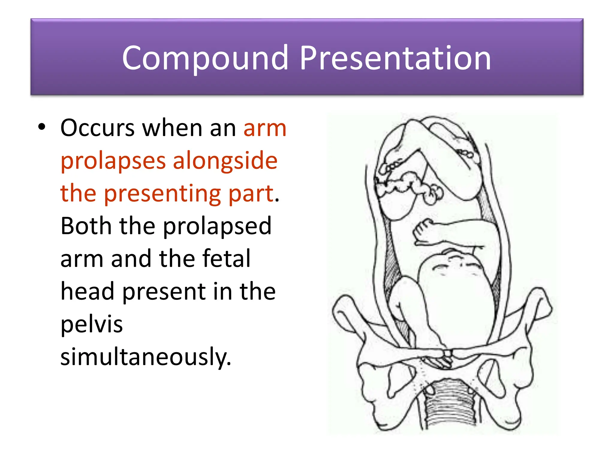 Compound Presentation
• Occurs when an arm
prolapses alongside
the presenting part.
Both the prolapsed
arm and the fetal
head present in the
pelvis
simultaneously.
 