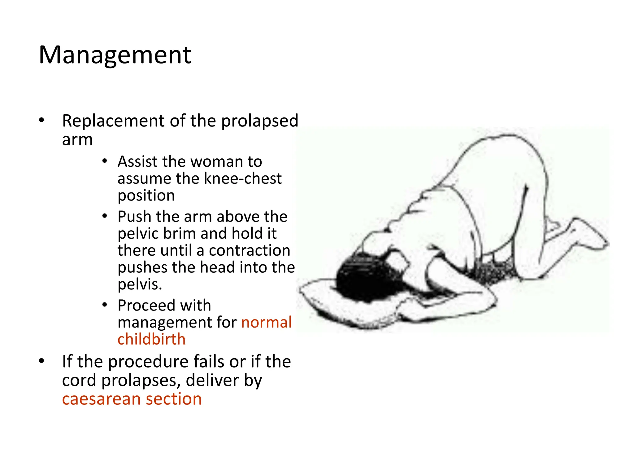 Management
• Replacement of the prolapsed
arm
• Assist the woman to
assume the knee-chest
position
• Push the arm above the
pelvic brim and hold it
there until a contraction
pushes the head into the
pelvis.
• Proceed with
management for normal
childbirth
• If the procedure fails or if the
cord prolapses, deliver by
caesarean section
 