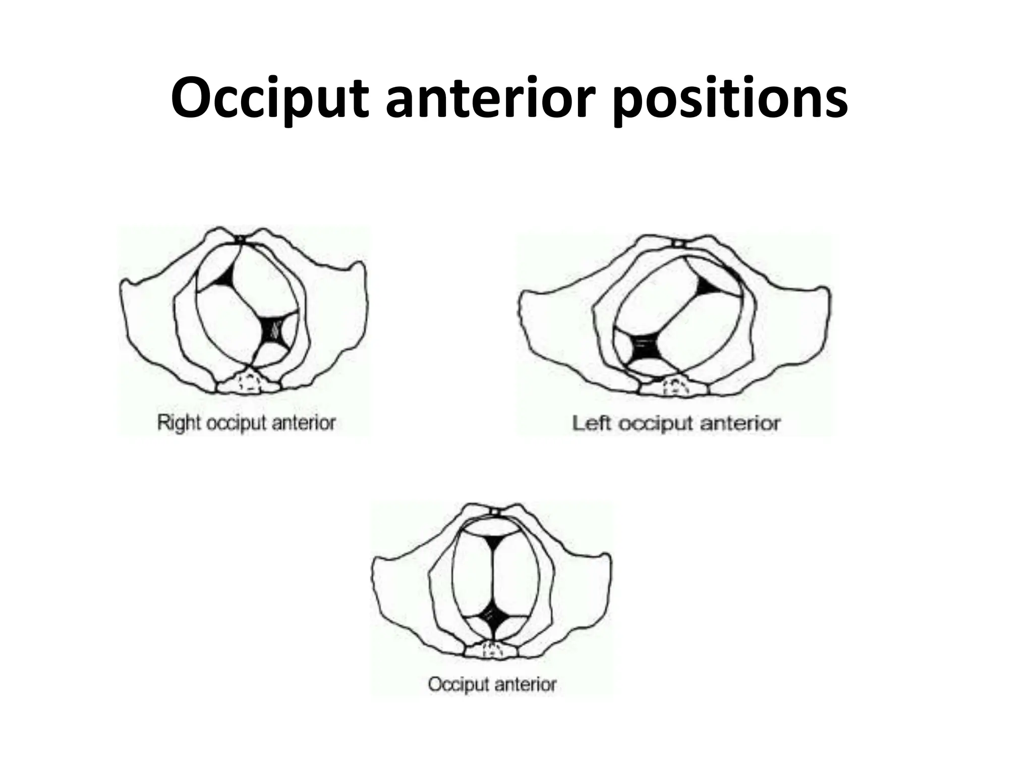 Occiput anterior positions
 