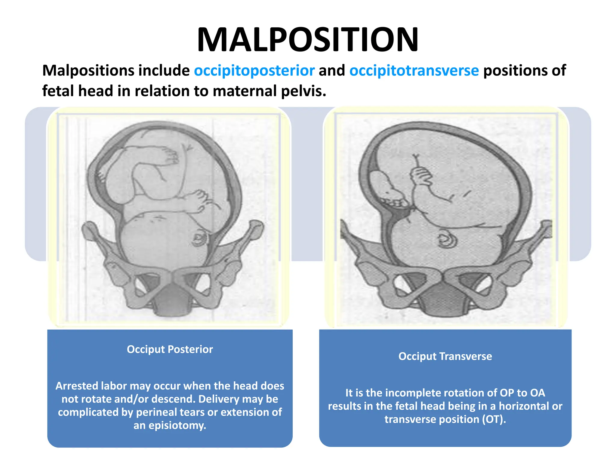 MALPOSITION
Occiput Posterior
Arrested labor may occur when the head does
not rotate and/or descend. Delivery may be
complicated by perineal tears or extension of
an episiotomy.
Occiput Transverse
It is the incomplete rotation of OP to OA
results in the fetal head being in a horizontal or
transverse position (OT).
Malpositions include occipitoposterior and occipitotransverse positions of
fetal head in relation to maternal pelvis.
 