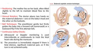 ECV & ICV procedure used in breech deliv | PPTX