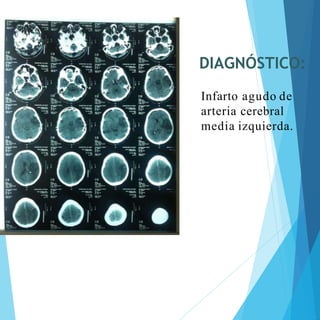 DIAGNÓSTICO:
Infarto agudo de
arteria cerebral
media izquierda.
 