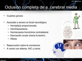 ECV Isquemica



    Oclusión completa de a. cerebral media
•    Cuadros graves

•    Asociado a severo sx focal neurológico.
      – Hemiplejía proporcionada.
      – Hemihipoestesia.
      – Hemianopsia homónima contralateral.
      – Desviación ocular (hacia la lesión).
      – Afasia

•    Repercusión sobre la conciencia.
•    A veces con edema, HIC y coma.
 