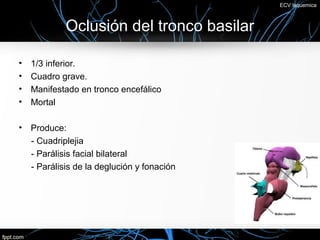 ECV Isquemica



             Oclusión del tronco basilar

•   1/3 inferior.
•   Cuadro grave.
•   Manifestado en tronco encefálico
•   Mortal

•   Produce:
    - Cuadriplejia
    - Parálisis facial bilateral
    - Parálisis de la deglución y fonación
 