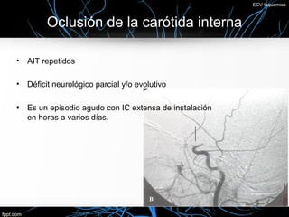 ECV Isquemica



         Oclusión de la carótida interna

•   AIT repetidos

•   Déficit neurológico parcial y/o evolutivo

•   Es un episodio agudo con IC extensa de instalación
    en horas a varios días.
 