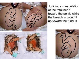 Judicious manipulation
of the fetal head
toward the pelvis while
the breech is brought
up toward the fundus
 