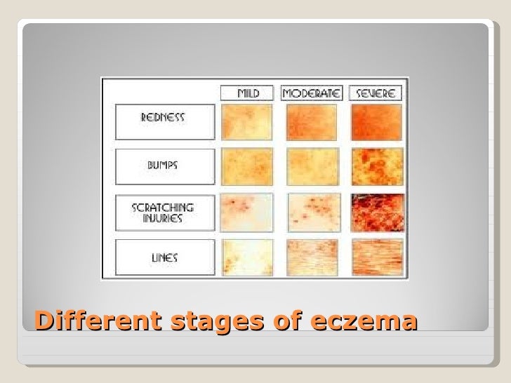 Eczema