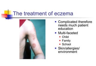 The treatment of eczema Complicated therefore needs much patient education Multi-faceted Child Family School Skin/allergies/ environment 