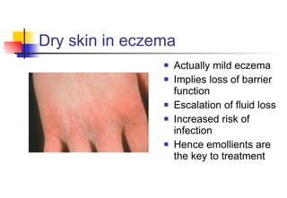Dry skin in eczema Actually mild eczema Implies loss of barrier function Escalation of fluid loss Increased risk of infection Hence emollients are the key to treatment 