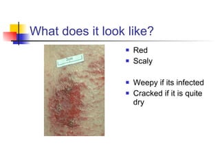 What does it look like? Red Scaly Weepy if its infected Cracked if it is quite dry 