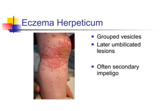 Eczema Herpeticum Grouped vesicles Later umbilicated lesions  Often secondary impetigo 