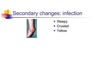 Secondary changes: infection Weepy Crusted Yellow 