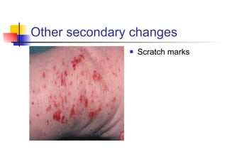 Other secondary changes  Scratch marks 