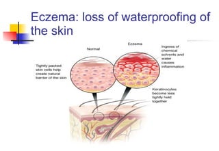 Eczema: loss of waterproofing of the skin 