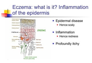 Eczema: what is it? Inflammation of the epidermis ,[object Object],[object Object],[object Object],[object Object],[object Object]