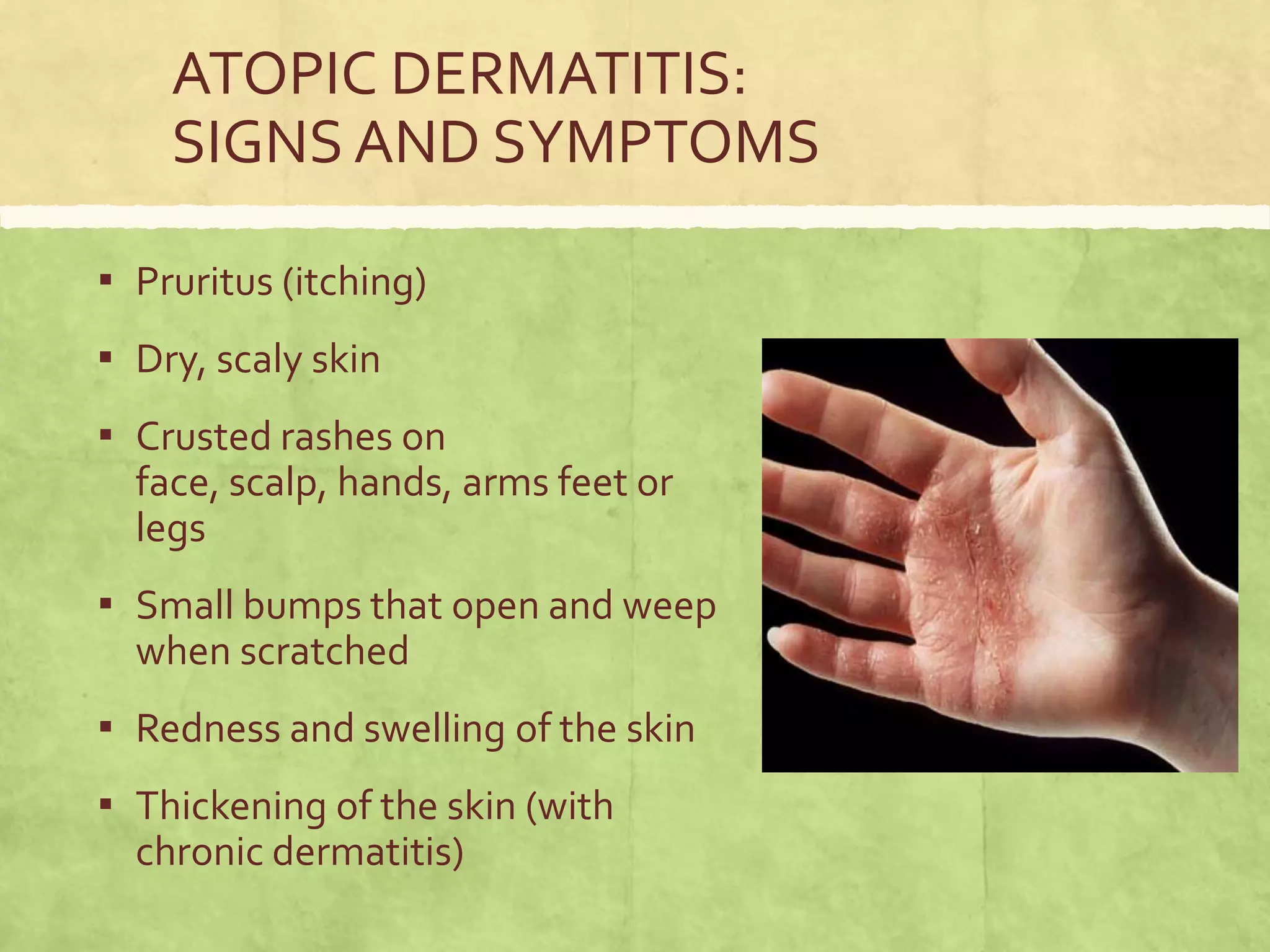 Eczema by Manaswi | PPTX