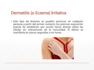 Dermatitis (o Eczema) Irritativa 
▪ Este tipo de lesiones se pueden provocar en cualquier 
persona a partir del primer contacto (no precisan exposición 
previa) Se establecen por acción lesiva directa sobre las 
células sin intervención de la inmunidad. El efecto se 
manifiesta en pocos segundos o en horas. 
 