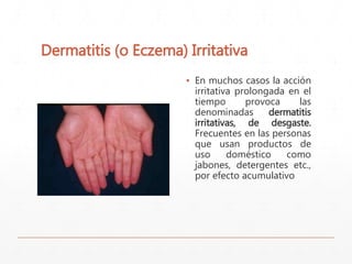 Dermatitis (o Eczema) Irritativa 
▪ En muchos casos la acción 
irritativa prolongada en el 
tiempo provoca las 
denominadas dermatitis 
irritativas, de desgaste. 
Frecuentes en las personas 
que usan productos de 
uso doméstico como 
jabones, detergentes etc., 
por efecto acumulativo 
 