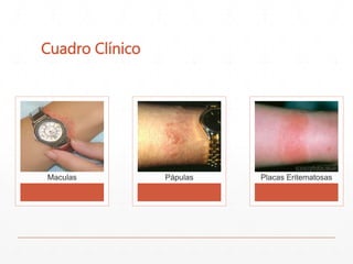 Cuadro Clínico 
Maculas Pápulas Placas Eritematosas 
 