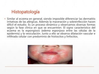 Histopatología 
▪ Similar al eczema en general, siendo imposible diferenciar las dermatitis 
irritativas de las alérgicas. Además la maceración y sobreinfección hacen 
difícil el estudio. Es un proceso dinámico y observamos diversas formas 
según la fase clínica en que se encuentren. El signo característico del 
eczema es la espongiosis (edema esponjoso entre las células de la 
epidermis) y la vesiculación. Junto a ello se observa dilatación vascular e 
infiltrado celular con predominio de histiocitos y linfocitos. 
 