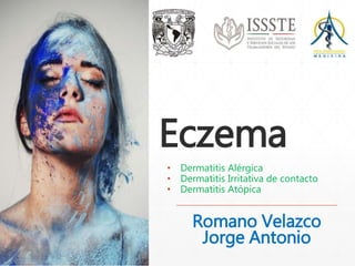 Eczema 
• Dermatitis Alérgica 
• Dermatitis Irritativa de contacto 
• Dermatitis Atópica 
Romano Velazco 
Jorge Antonio 
 