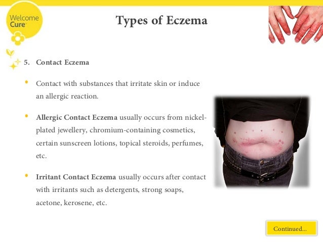 Homeopatic releive for eczema