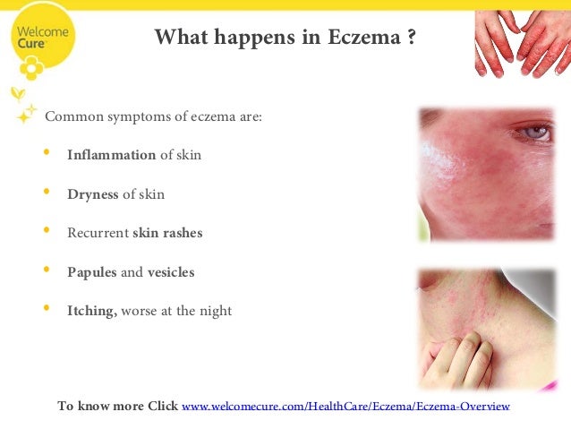 How to relieve eczema itch