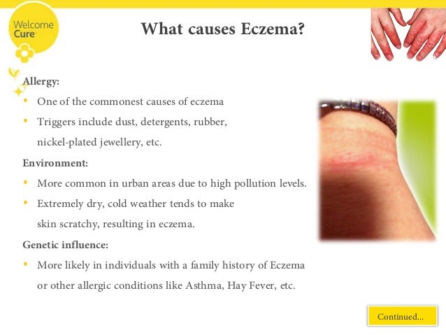 Homeopatic releive for eczema