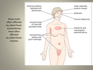 Areas most
often affected
by seborrhoeic
eczemaAreas
most often
affected
by seborrhoeic
eczema
 