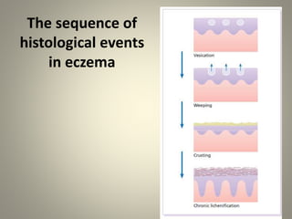 The sequence of
histological events
in eczema
 