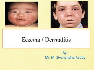 Eczema / Dermatitis
By:
Mr. M. Sivanandha Reddy
 