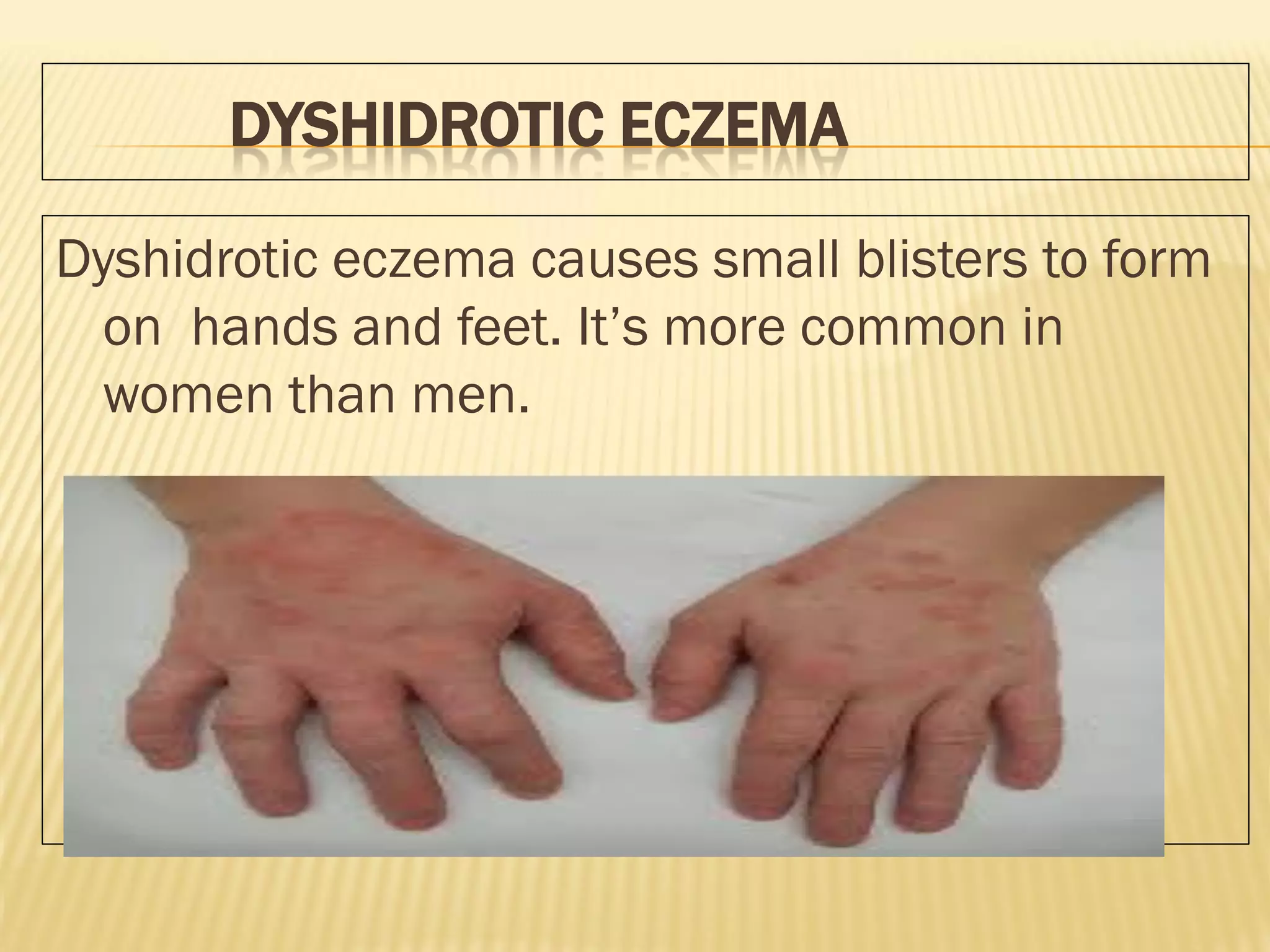 eczema-pdf