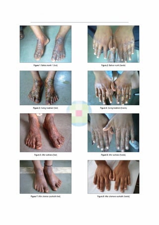 Figure 1: Before month 1 (feet) Figure 2: Before month (hands)
Figure 3: During treatment (feet) Figure 4: During treatment (hands)
Figure 5: After sodhana (feet) Figure 6: After sodhana (hands)
Figure 7: After shaman (oushadhi feet) Figure 8: After shamana oushadhi (hands)
 