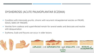 DYSHIDROSIS (ACUTE PALMOPLANTAR ECZEMA)
 Condition with intensively pruritic, chronic with recurrent intraepidermal vesicles on PALMS,
SOLES, SIDES OF FINGERS
 Vesicles form coalesce and superinfected remain for several weeks and desiccate and resolve
with desquamation
 Erythema, Scale and fissures can occur in older lesions
 