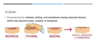 ECZEMA -
 Characterized by redness, itching, and sometimes oozing vesicular lesions,
which may become scaly, crusted, or hardened.
 