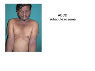 ABCD
subacute eczema
 