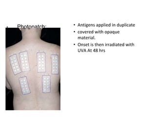 • Photopatch: • Antigens applied in duplicate
• covered with opaque
material.
• Onset is then irradiated with
UVA At 48 hrs
 
