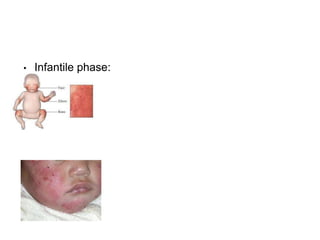 • Infantile phase:
 