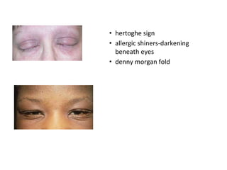 • hertoghe sign
• allergic shiners-darkening
beneath eyes
• denny morgan fold
 