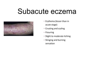 Subacute eczema
▪ Erythema (lesser than in
acute stage)
▪ Crusting and scaling
▪ Fissuring
▪ Slight to moderate itching
▪ Stinging and burning
sensation
 