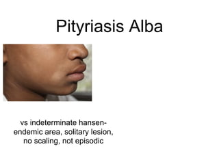 Pityriasis Alba
vs indeterminate hansen-
endemic area, solitary lesion,
no scaling, not episodic
 