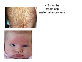 < 3 months
cradle cap
maternal androgens
 