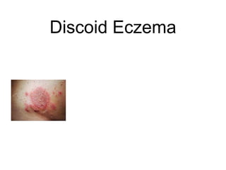 Discoid Eczema
 